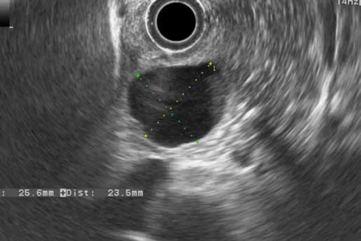 EUS – groove pancreatitis: cyst in the duodenal wall (patient 4).
Obr. 5. EUS – žliabková pankreatitída: cysta v stene duodéna (pacient č. 4).