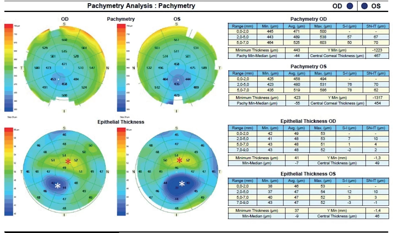 OCT Pachymetry of keratoconus – clinically manifested in both eyes. White asterisk – epithelial thinning on the apex of the cone, red asterisk – epithelial thickening near the base of the cone