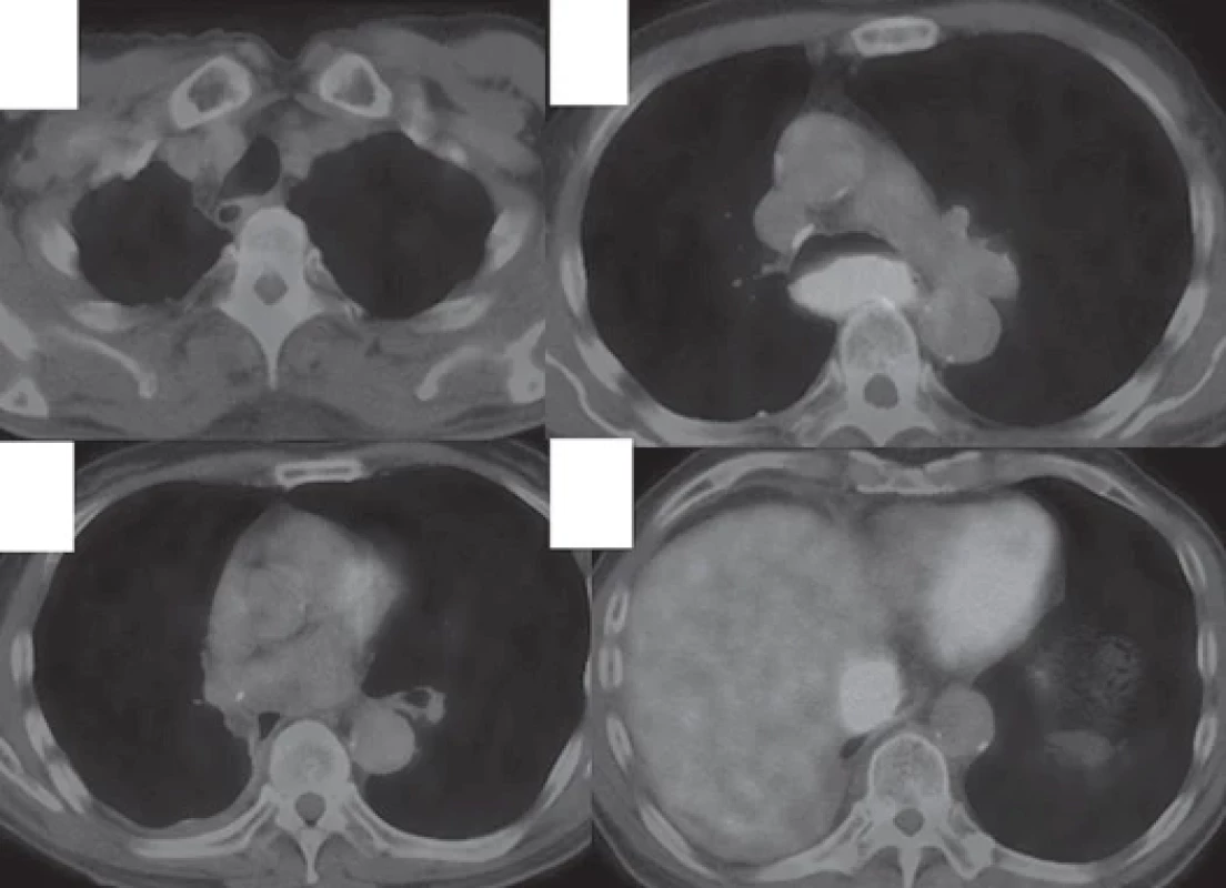 PET/CT scan taken 18 months after the initiation of the therapy revealed disappearance of pleural dissemination (A, B) but deterioration of the reasons in the mediastinal lymph nodes (C, D).
