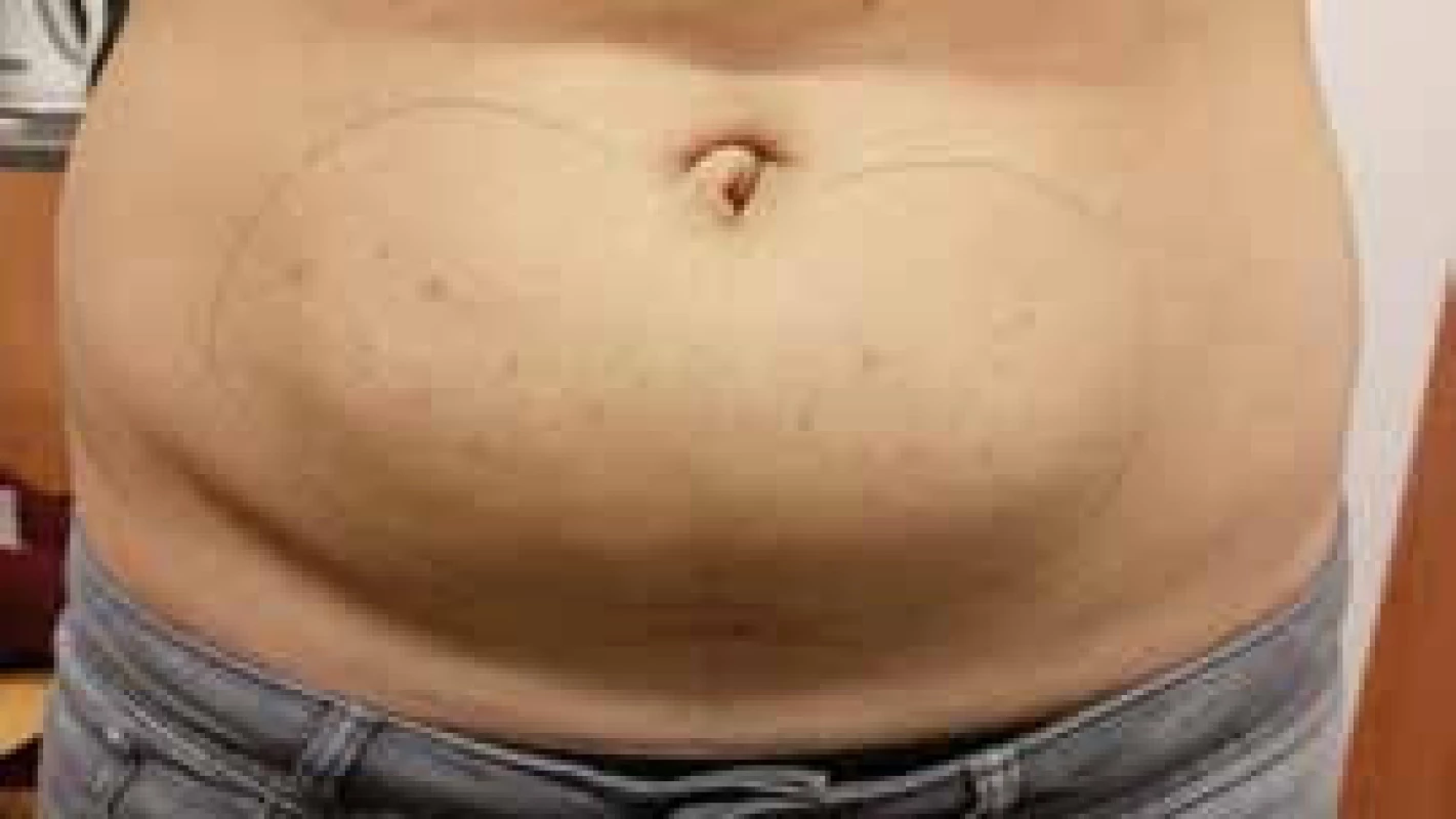 Lipohypertrofická tkáň