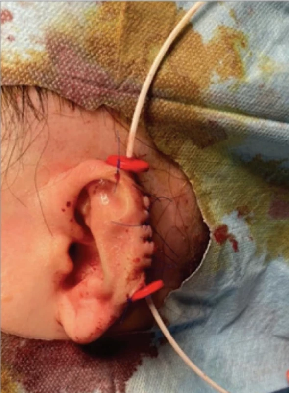 Result at the end of the surgery after insertion of a catheter for subsequent brachytherapy.