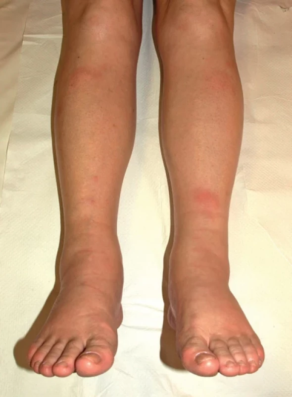 Erythema nodosum (archiv RÚ)