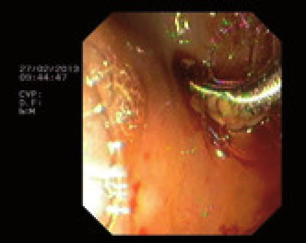 Použití Soehendra retrieveru.
Fig. 3. Using Soehendra retriever.