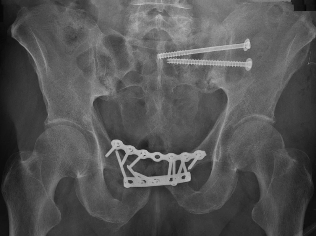 Osteosyntéza předního segmentu pánve dvěma dlahami a zadního segmentu vlevo dvěma iliosakrálními šrouby
Fig. 3: Internal fixation of the anterior pelvic segment with two plates and the posterior left segment with two iliosacral screws