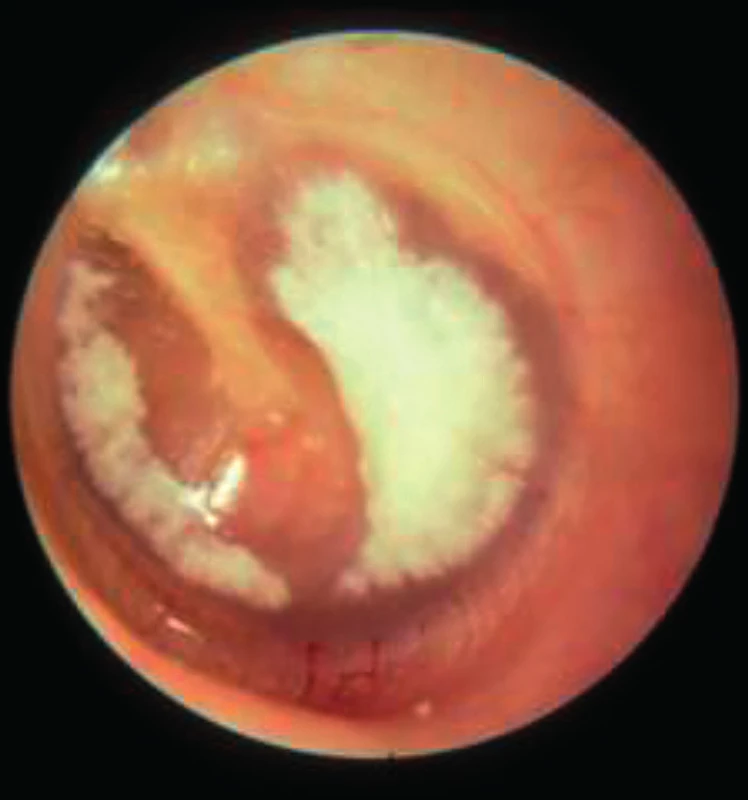 Myringoskleróza – vápenaté inkrustace bubínku.
Fig. 6. Myringosclerosis – calcium plates of the tympanic membrane.