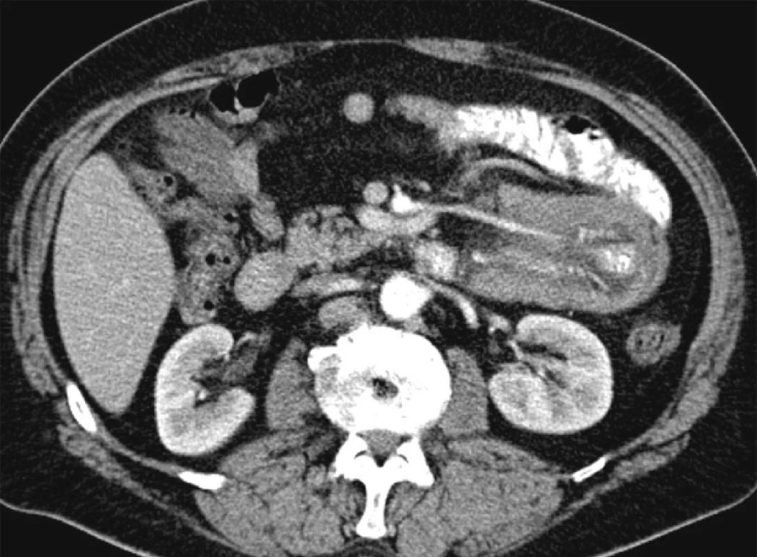 Začátek invaginace s nataženými cévami mezenteria
Fig. 1. The invagination origin with mesenteric vessels