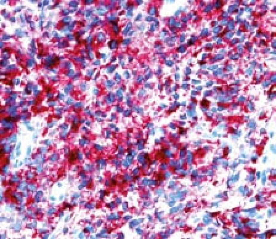 Metastáza melanomu v jejunu, kličková polpyektomie. Imunohistochemické vyšetření – HMB 45 pozitivita.
Fig. 7. Small bowell metastatic melanoma, snare polypectomy. Imunohistochemy – HMB 45 positivity. 