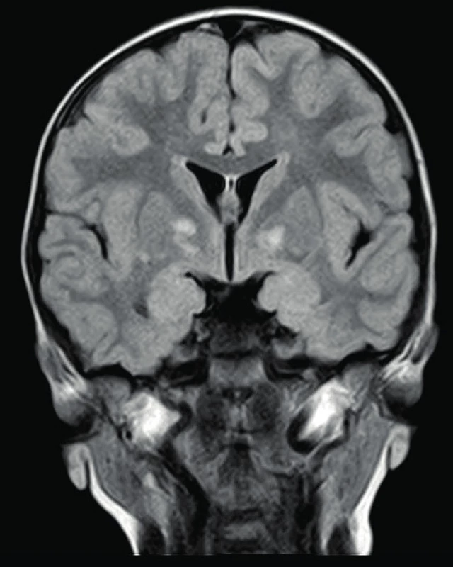 Hamartogenní ložiska v globus pallidus, T2, FLAIR 
Fig. 2. Hamartogenous bearing in globus pallidus, T2 and FLAIR