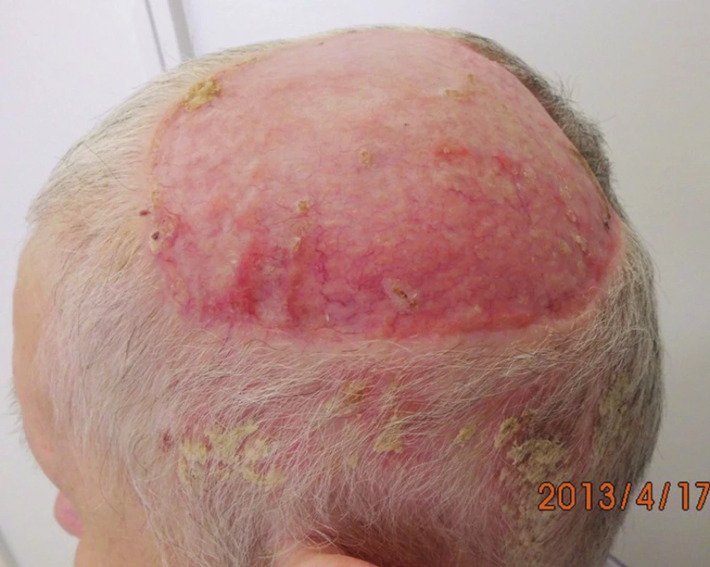 Stav po totální excizi maligního melanomu kštice a krytí defektu dermoepidermálním kožním autotransplantátem
Fig. 7: Status after excision of malignant melanoma of the scalp and covering of the defect with split-thickness skin graft
