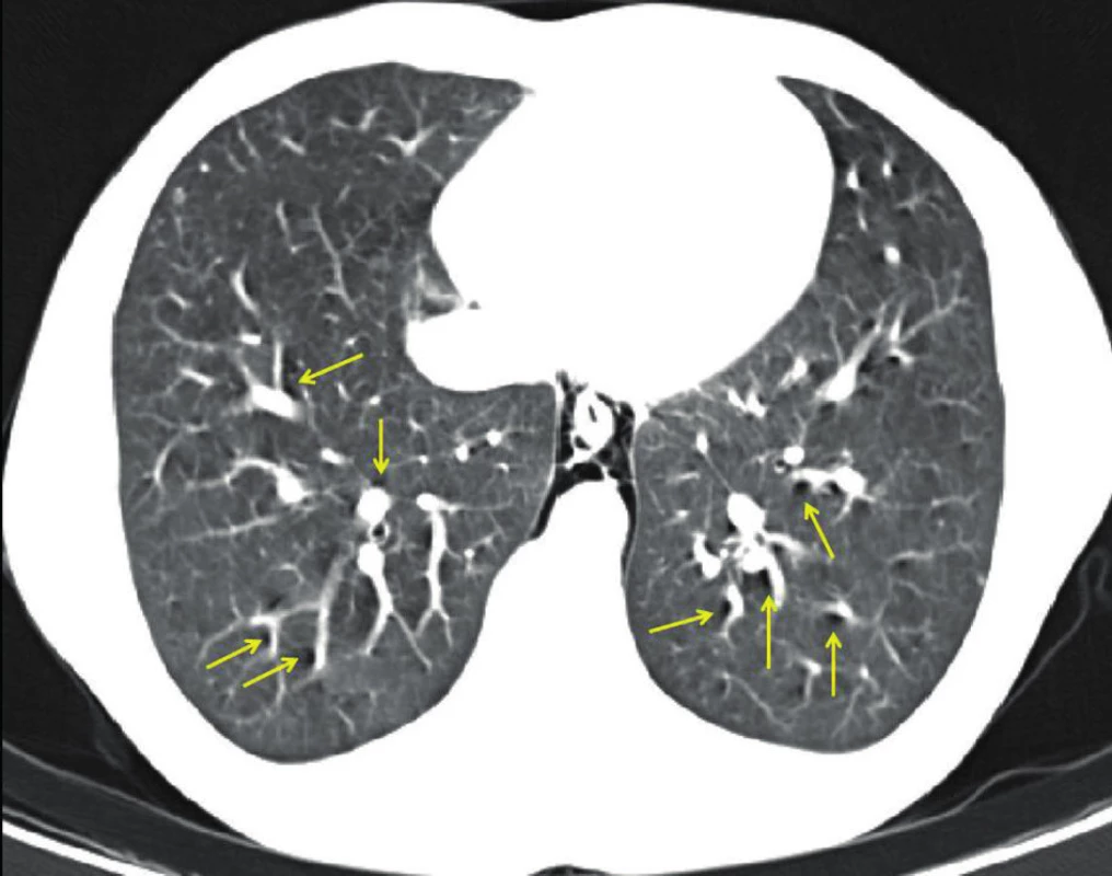 CT obraz spontánního pneumomediastina a plicního intersticiálního emfyzému (Macklinův efekt – označeno žlutými šipkami.)
Fig. 1: CT image of spontaneous pneumomediastinum and pulmonary interstitial emphysema (Macklin effect – indicated by yellow arrows.)
