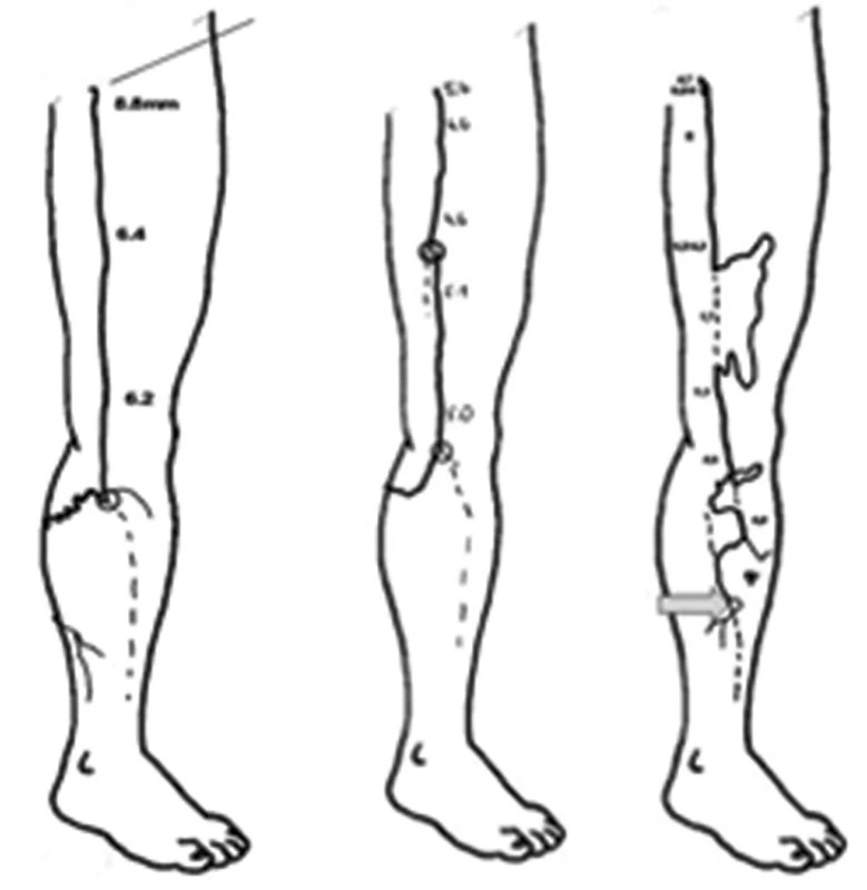 Detailní sonografické vyšetření, šipka označuje distální bod insuficience VSM
Fig. 3: Detailed sonographic examination, the arrow points at the distal point of GSV insufficiency