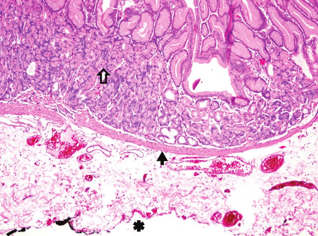 Histologický preparát – mikroskopický obraz steny divertikula - mucosa, - lamina muscularis mucosae, - tušom značený povrch divertikula tvorený riedkym väzivom. (Lamina muscularis propria chýba – ide o nepravý divertikul. Hematoxylín a eozín, 100x.) 
Fig. 6: Histological preparation – microscopic image of the diverticulum wall- mucosa, - lamina muscularis mucosae, - ink-labelled surface of the diverticulum formed by sparse ligaments (The lamina muscularis propria is lacking – it is a false diverticulum. Hematoxylin and eosin, 100x.)