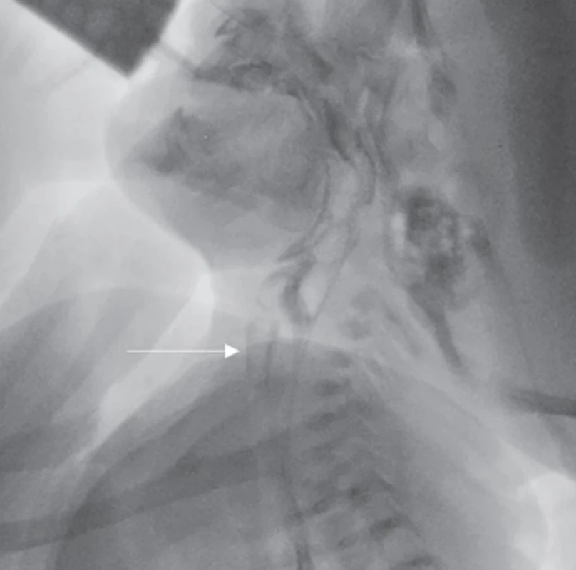 Videofluoroskopie polykacího aktu s vyznačenou aspirační epizodou.  Fig. 1. Videofluoroscopy of the swallowing act with marked aspiration episode. 