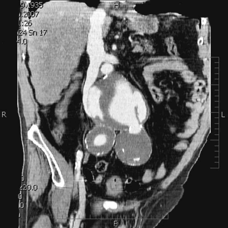 CTA rekonstrukce velkého aneuryzmatu subrenální aorty a společných pánevních tepen s rupturou do dolní duté žíly.
Fig. 4. CTA recontruction of  the large subrenal aortic aneuysm and common pelvic arteries with a rupture into the inferior vena cava.
