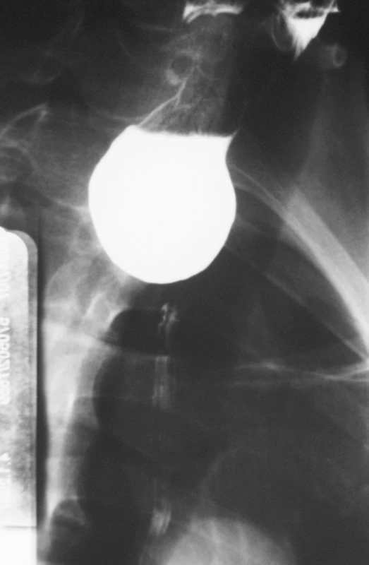 RTG obraz Zenkerova divertiklu
Fig. 1. X-ray view of the Zenker’s diverticle
