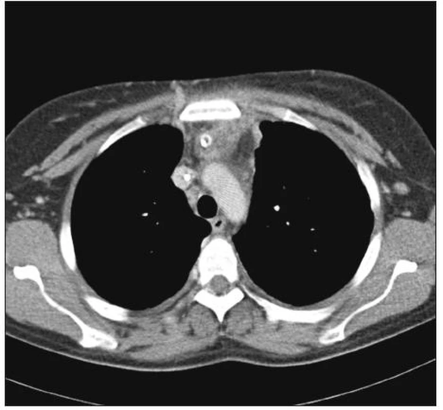 Z.n. Mediastinotomie und Abszess-Evakuation mit Drainage des vorderen Abszesses im Unterhaut-