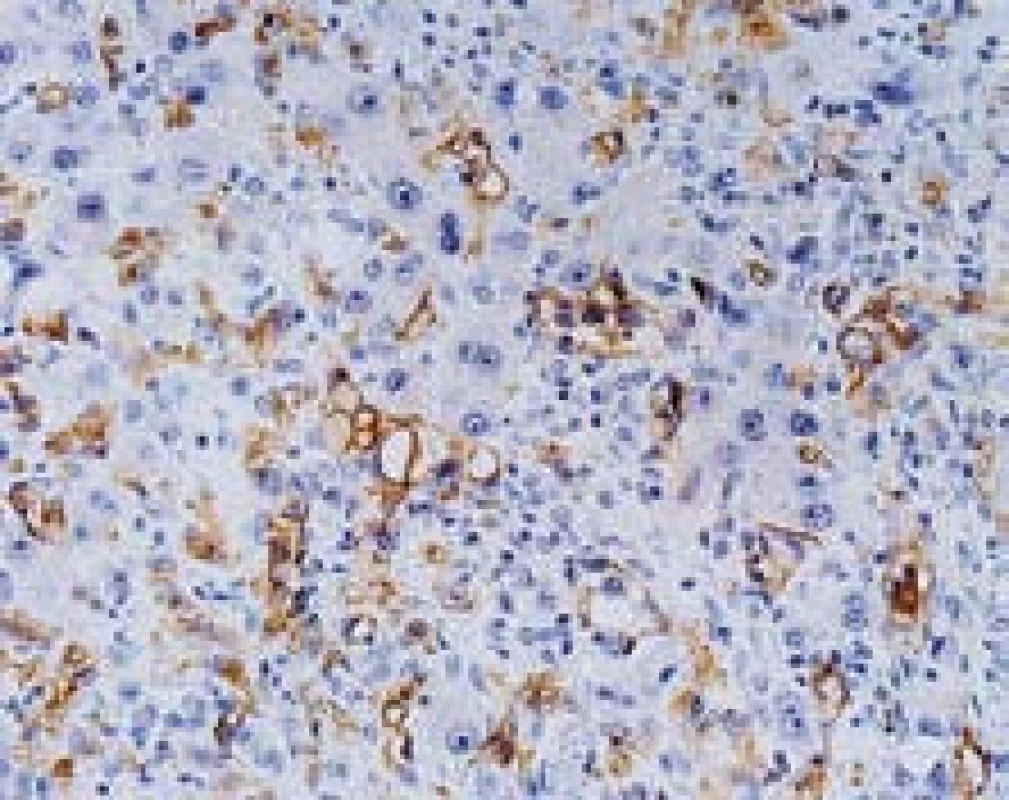 Epiteloidní hemangioendoteliom, imunohistochemický průkaz CD34 verifikuje endotel sinusů (nenádorový i nádorový), s pozitivními elementy šířícími se sinusy. Současně jsou dobře patrné cytologické reaktivní změny hepatocytů. Zvětšení objektiv 40×.
Fig. 6. Epithelioid hemangioendothelioma, immunoperoxidase detection of CD34 with positive staining in the endothelium (benign and malignant) with tumor cells spreading in the sinusoids. Reactive changes of hepatocytes are also shown, high power field.