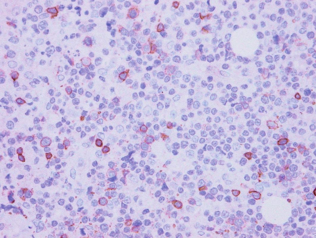 Vzorek z 2. bioptického odběru – DLBCL 
CD5 pozitivita minoritních disperzních buněk.