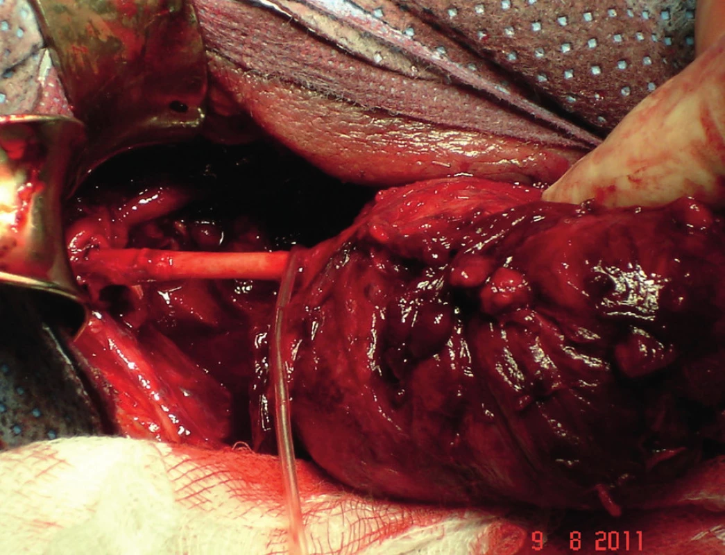 Po stažení tumoru nalezena kraniálně ACI
Fig. 5: Cranially, AIC was found after moving the tumour downwards