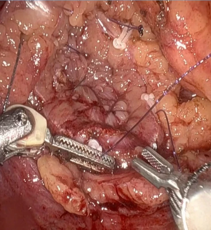 Ošetření resekční plochy.  Fig. 3. Suture of the resection area. 