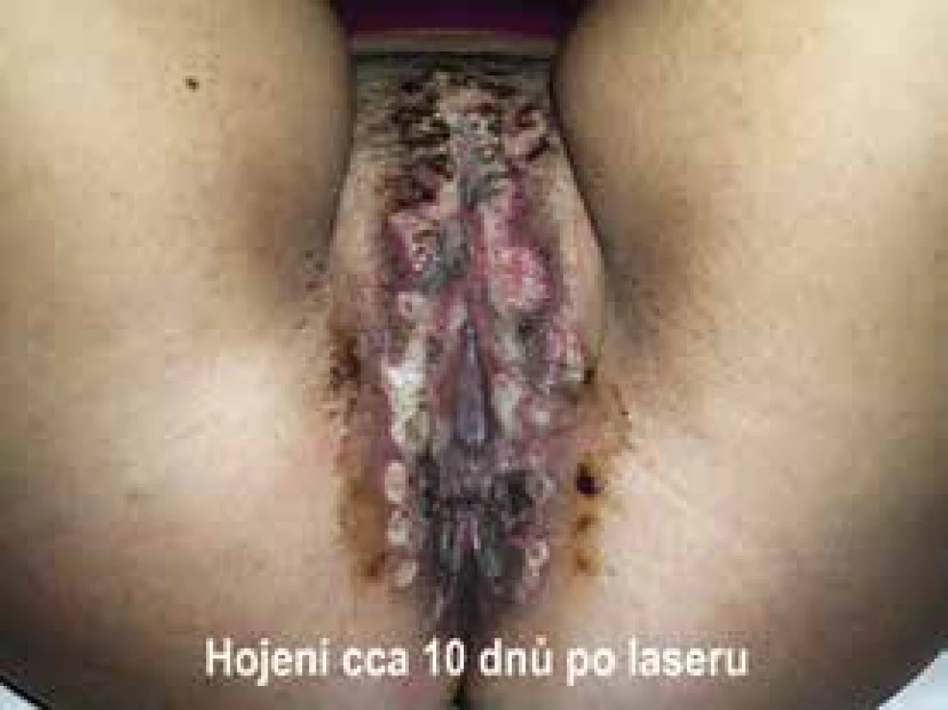 Stav hojení asi 10 dnů po ošetření laserem