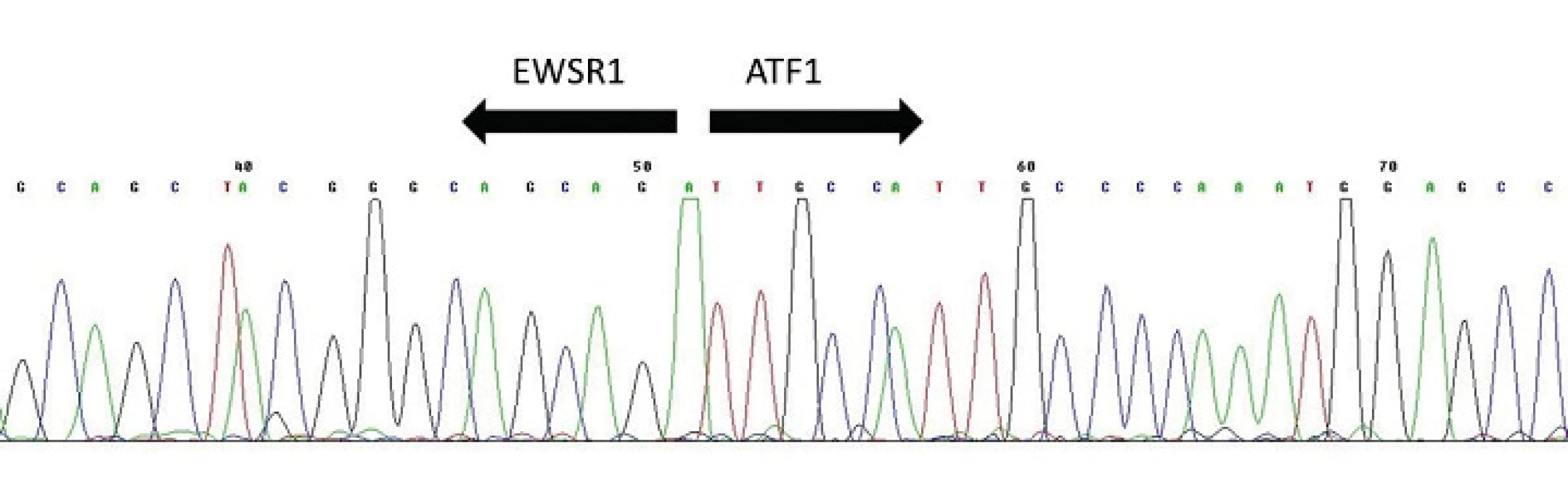 Sekvenogram fúzního transkriptu <i>EWSR1-ATF1</i>. Šipky vyznačují místo fúze.