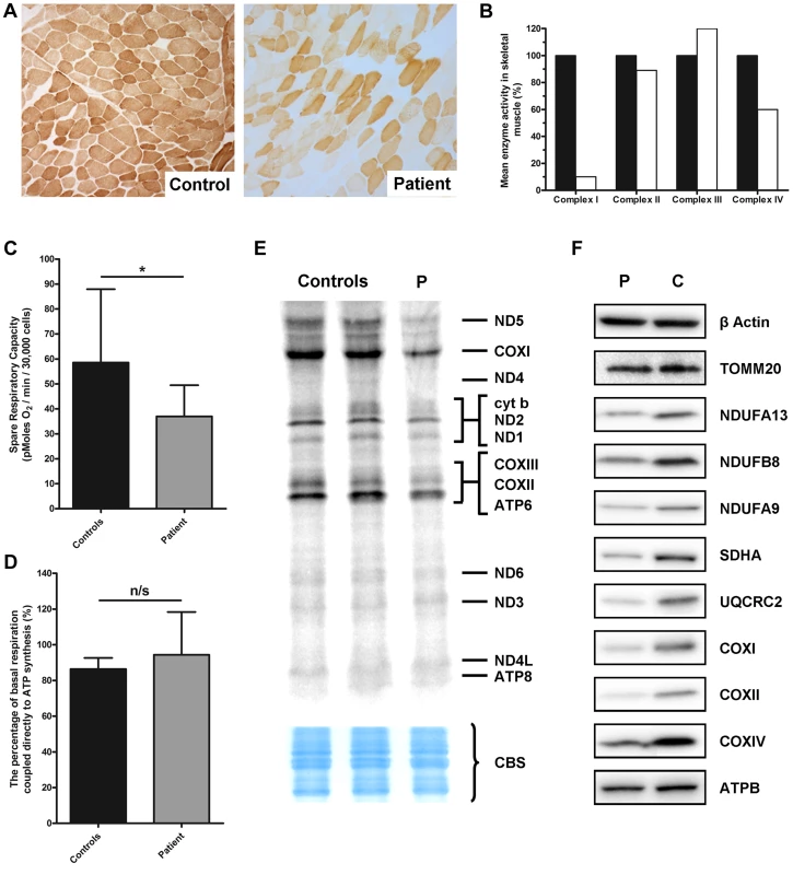 Identification of a mitochondrial respiratory chain deficiency and defective mtDNA translation.