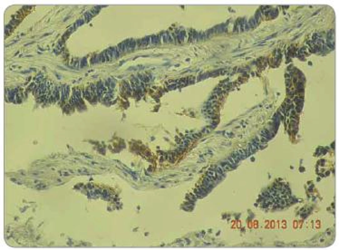 Hodnocení intenzity exprese EGFR pomocí IHC: EGFR 3+, zvětšení 200×.