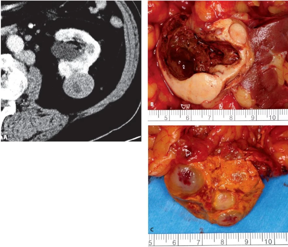 Muž 70 let, tumor levé ledviny T1b, mnohočetné paraaortální metastázy a metastáza nadledviny, provedena radikální levostranná nefrektomie s extenzivní paraaortální lymfadenketomií a adrenalektomií. Histologicky se jednalo o mucinózní tubulární a vřetenobuněčný renální karcinom. Metastázy však nebyly z renálního karcinomu, ale z dosud nediagnostikovaného karcinomu žaludku. A – CT ledviny axiální ve venózní fázi, B – preparát tumoru ledviny, C – preparát nadledviny s metastázami
Fig. 9. Seventy year old male, tumour of the left kidney T1b, paraaortic lymph node and adrenal gland metastases. Radical nephrectomy, adrenalectomy and lymph node dissection performed. Histology of renal tumour: mu-C cinous Tubular and Spindle Cell RCC. Metastases were from stomach cancer. A – axial CT in venous phase, B – specimen of kidney tumour, C – specimen of adrenal gland with metastases