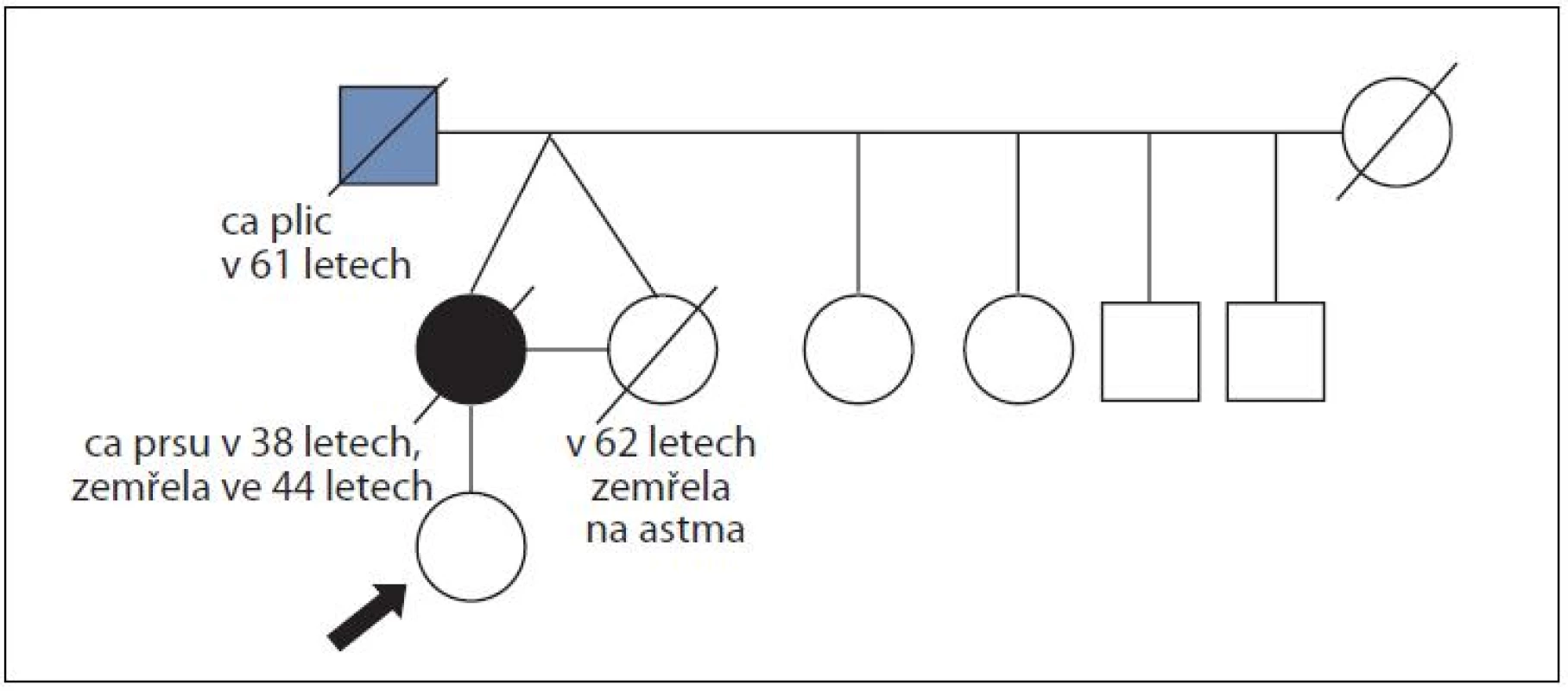 Rodina ženy s duktálním karcinomem prsu ve 38 letech a její monozygotní sestry, která zemřela na diagnózu nenádorového původu; časový interval sledování 24 let; mutace v <i>BRCA</i> genech nenalezena.