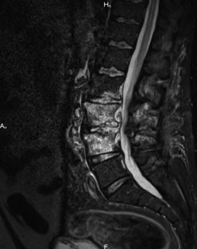 MR sekvence v sagitální rovině prokazuje významný edém obratlů L3 a L4 s patologickým signálem meziobratlových disků L2–L5 při spondylodiscitidě.