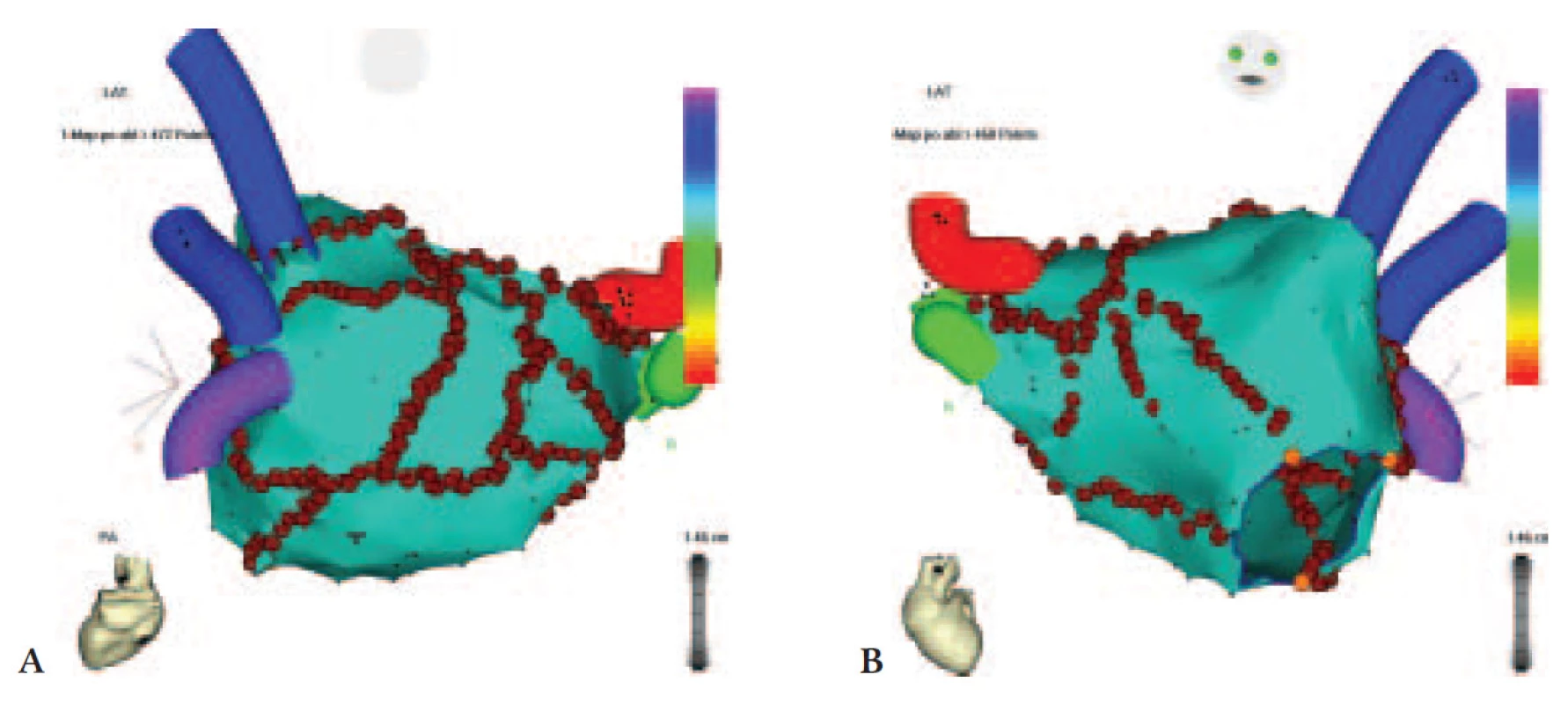Elektroanatomická mapa levé síně s katetrovou ablací pro fibrilaci síní.
