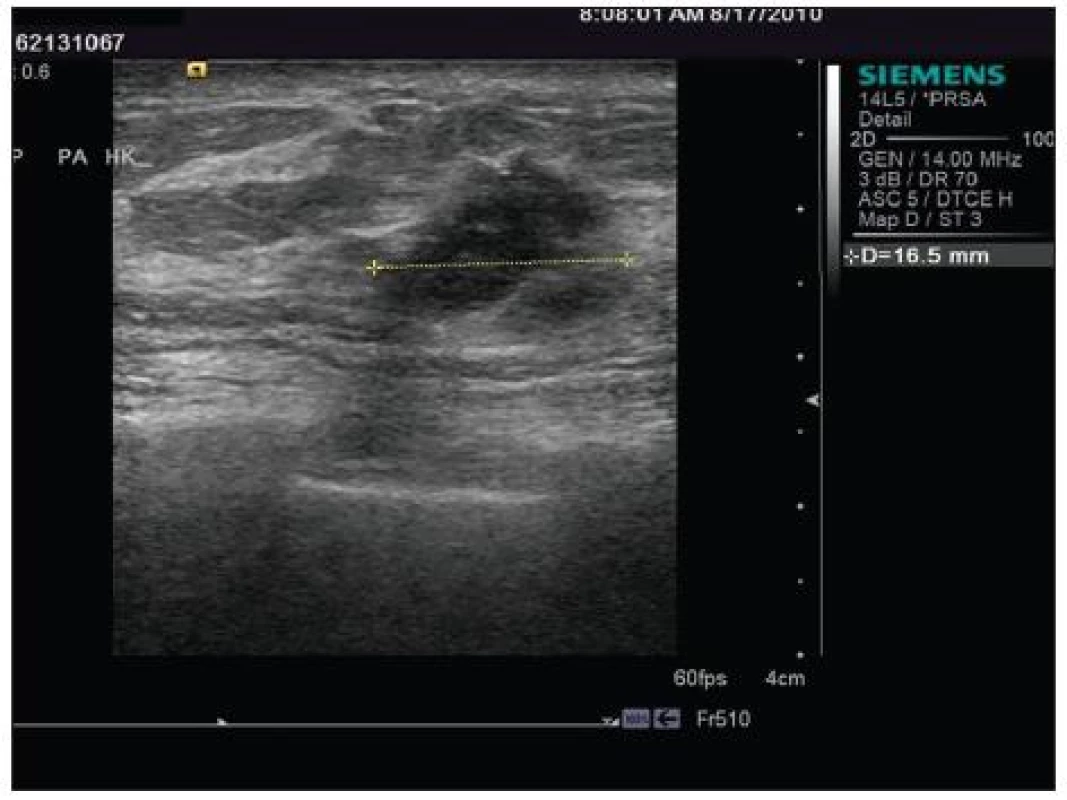 Sonografie pravého prsu
Fig. 11. Sonograpphy of the right breast