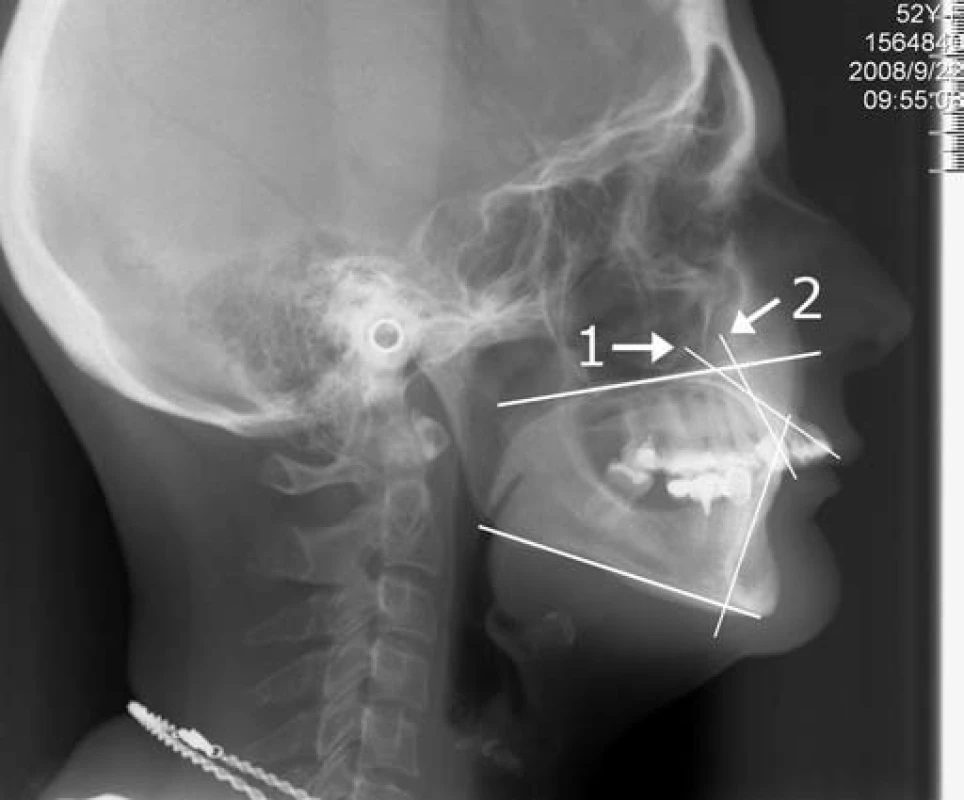 Bočná kefalometrická snímka pacientky č. 1. 1 – sklon horných rezákov oproti rovine tvrdého podnebia, 2 – fyziologická hodnota sklonu horných rezákov 
Fig. 3. Lateral cephalometric X-ray of patient No. 1. 1 – inclination of upper incisors against the plane of hard palate, 2 – physiological value of upper incisors inclination