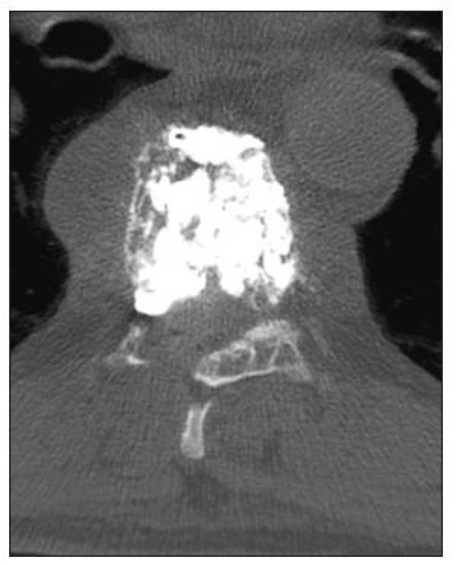 CT axiální sken obratle Th7 po vertebroplastice
Fig. 3. CT axial scan of TH7 following vertebroplasty