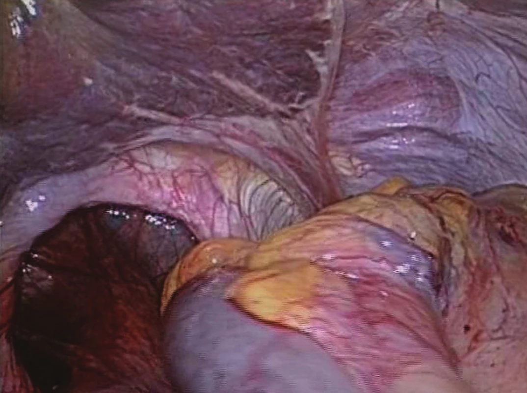 Defekt v bránici po repozici žaludku
Fig. 14: Diaphragm defect after reposition of the stomach