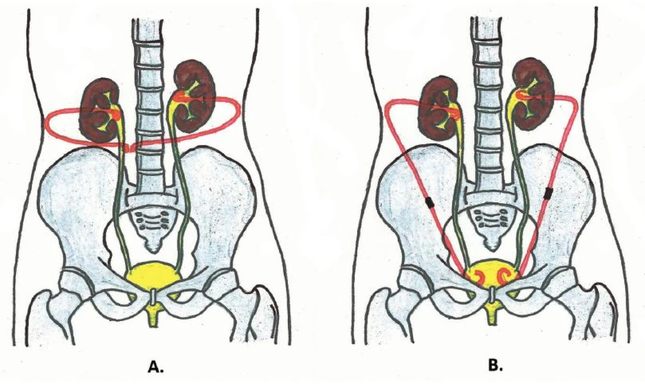 Schéma extraanatomického stentu
A – oboustranný nefrokutánní bypass; B – oboustranný nefrovezikální bypass
Fig. 1. Scheme of extra-anatomic stent
A – bilateral nephocutaneous bypass; B – bilateral nephrovesical bypass