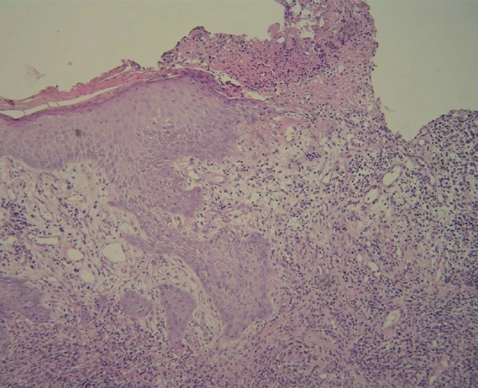 Akantotická epidermis přechází ve spodinu mělkého vředu (HE, orig. zvětšení 100x) (doc. MUDr. L. Pock).