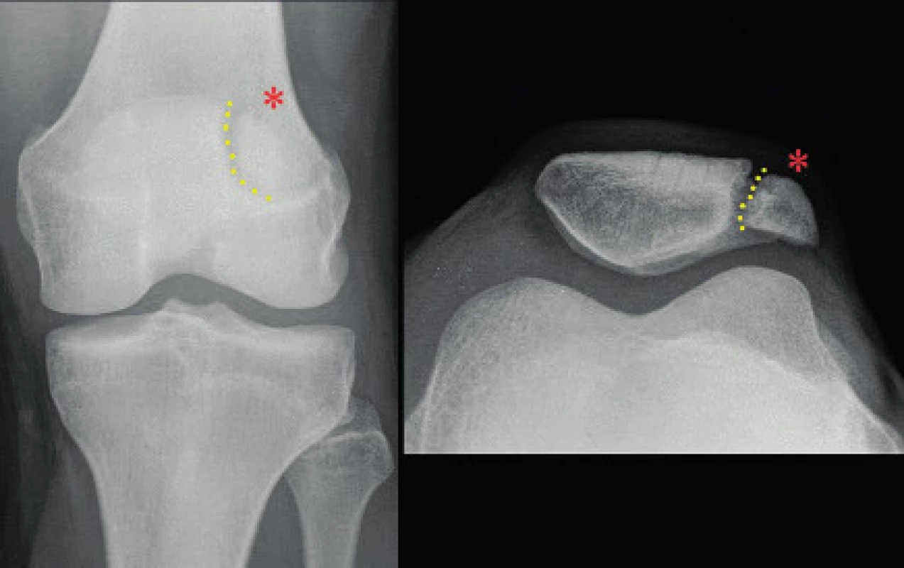 RTG snímek pately bipartity – dělení pately a volný fragment vyznačeny.
Fig. 3. X-ray of bipartite patella – the free patellar fragment separation marked.