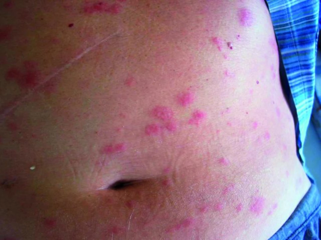 Akarodermatitida – detail