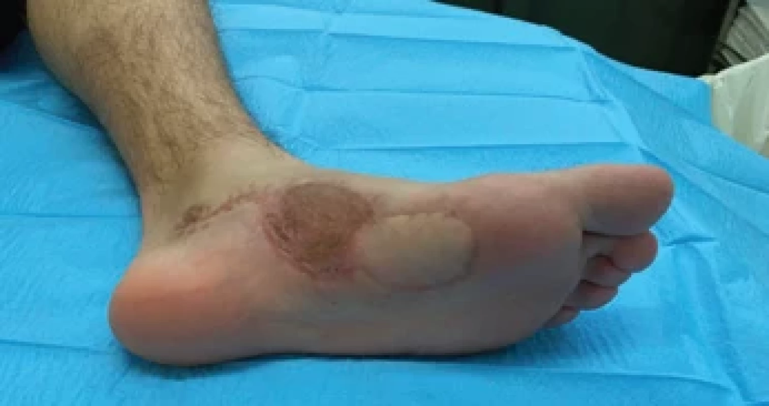 Final outcome at nine months postoperative with all wounds closed, fully weight-bearing and correct ambulation.