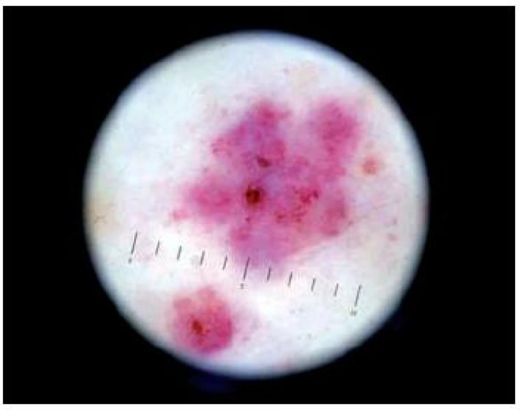 Vasculitis leukocytoklastická