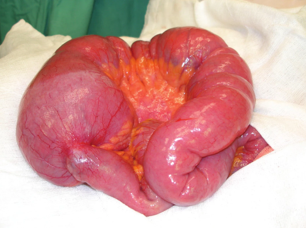 Distendované ileum a stenóza
Fig. 1: Distended ileum and stenosis