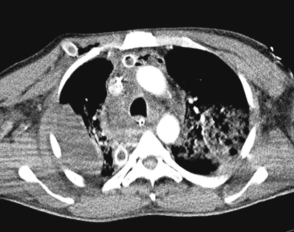 CT axiální obraz na úrovni bifurkace průdušnice, infiltrace mediastina s kolekcí v dorzální pravé čtvrtině
Fig. 2. CT axial view at the trachea bifurcation level, mediastinal infiltration with a density in the right posterior quarter