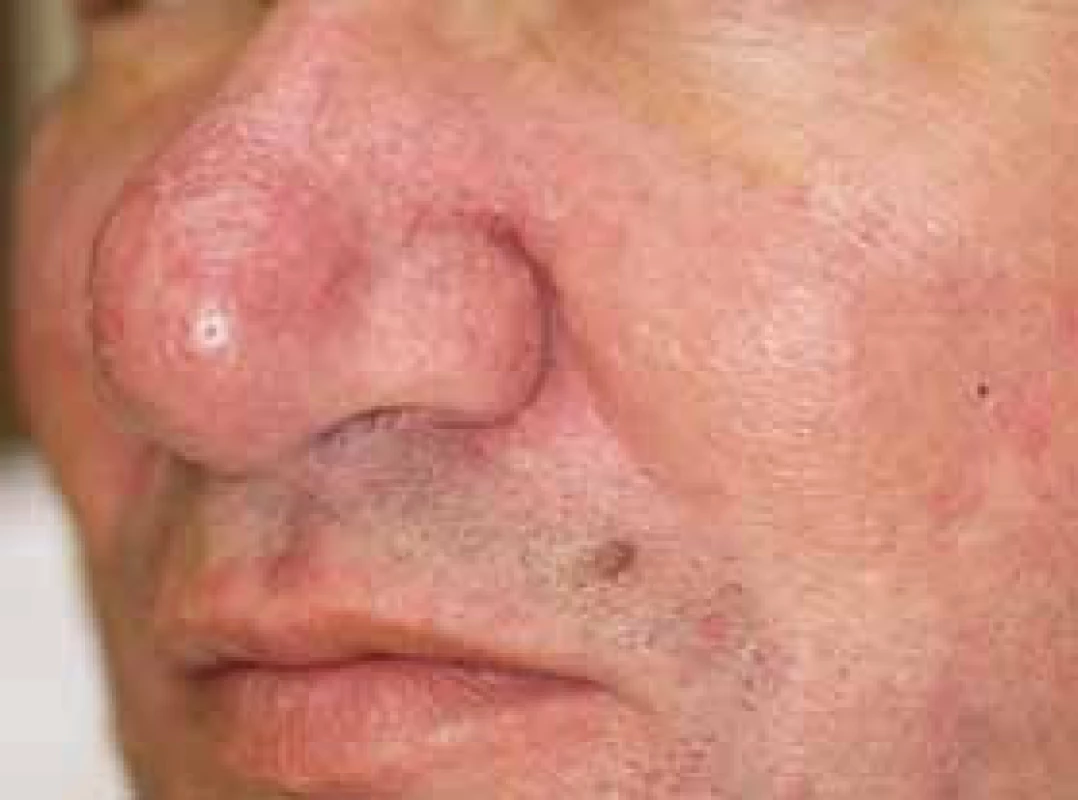 Rhinophyma téhož pacienta
Fig. 2.
Rhinophyma of the same patient