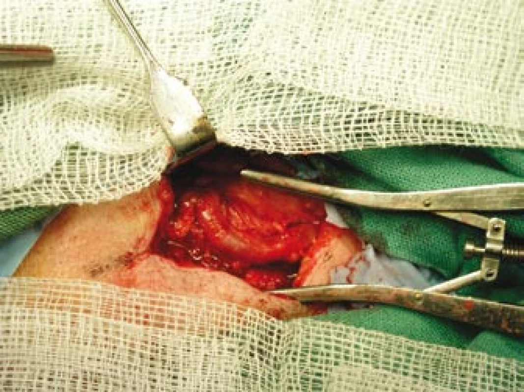 Vypreparovaná větev pravostranné temporální arterie.