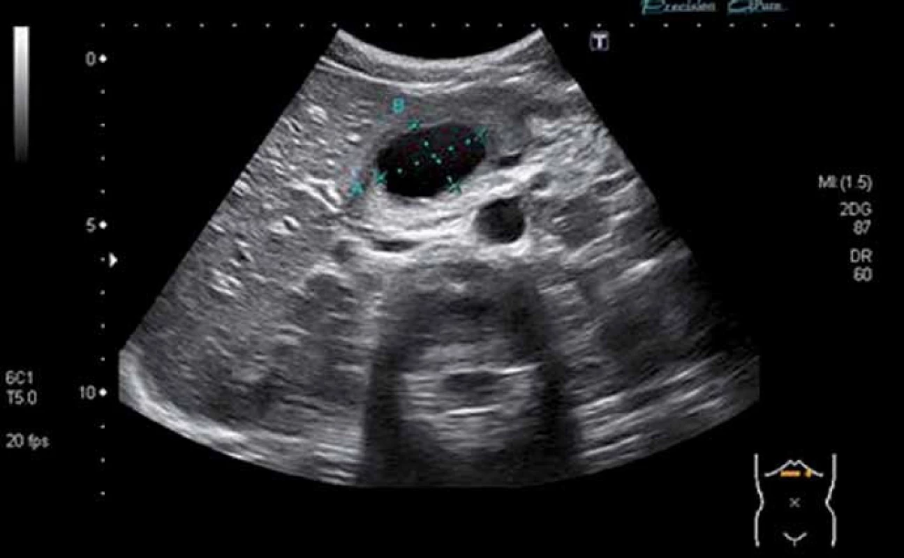 Sonografický obraz potraumatické pseudocysty (36 × 25 mm) v oblasti hlavy pankreatu.
Fig. 6. The abdominal ultrasonography showing the posttraumatic pseudocyst (36 × 25 mm) of the pancreatic head.
