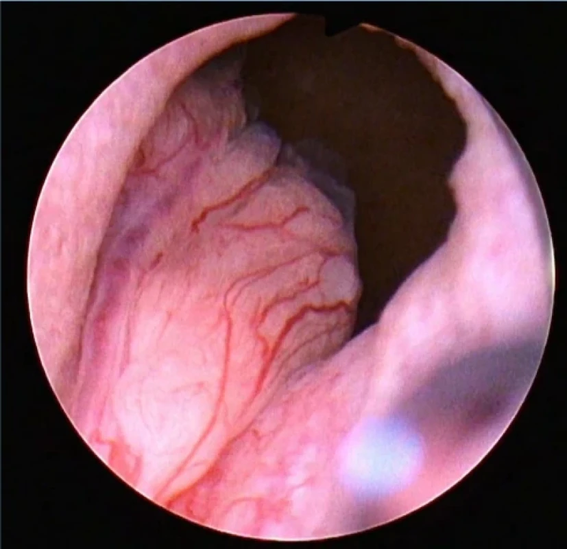 Uretrocystoskopie IUP, pohled do močového měchýře. Fig. 2. IUP urethrocystoscopy, view of the bladder. 