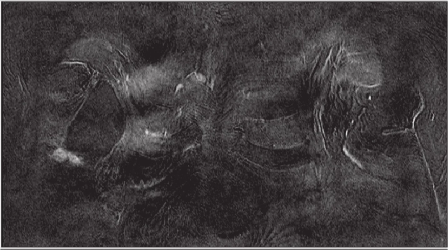 MR prsů v červnu 2011
Fig. 4: Breast MRI in June 2011