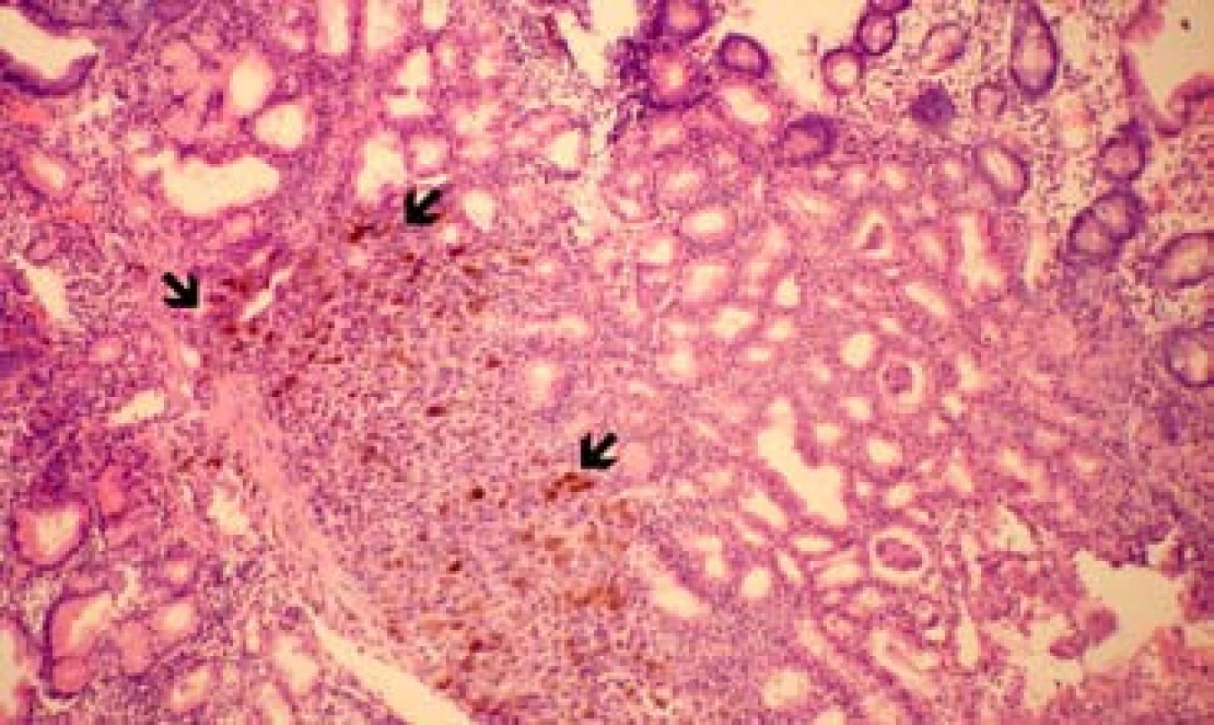 Solidní struktura metastázy maligního melanomu s depozity tmavého pigmentu (melaninu) ve sliznici duodena – označeno šipkami (klešťová biopsie, barvení hematoxylin-eozin, zvětšeno 100×).
Fig. 2. A metastatic mass of malignant melanoma with melanin pigment deposits in the duodenal mucose – marked with arrows (forceps biopsy, hematoxylin-eosin staining, enlarged 100×).